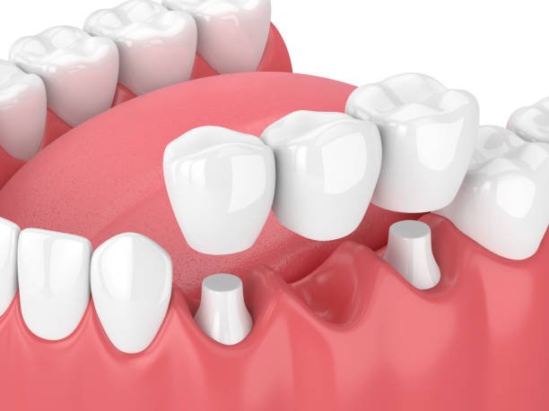 3d render of jaw with dental bridge over white background