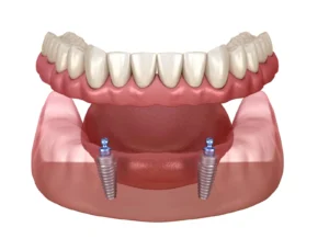 Implants for dentures scaled 1
