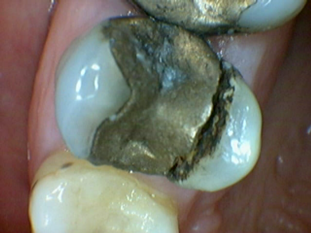 Fractured premolar cusp separated from amalgam mercury filling