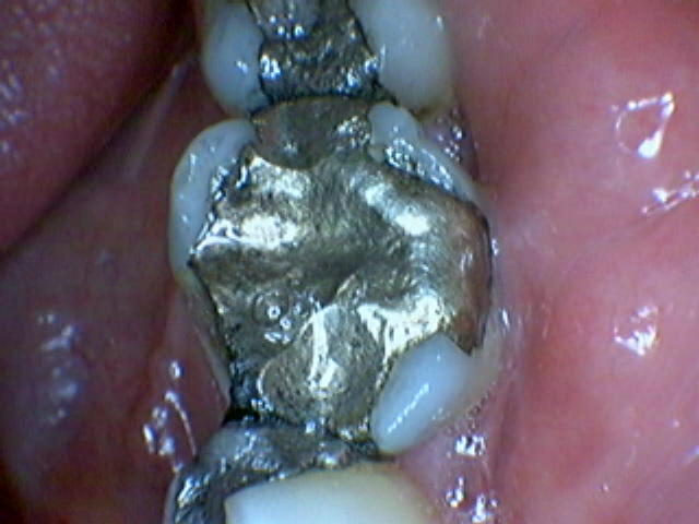 Fractured tooth cusp around old amalgam mercury filling