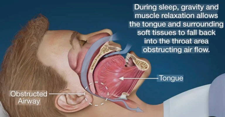 Diagram showing how relaxed throat tissues and the tongue can block the airway and cause snoring during sleep
