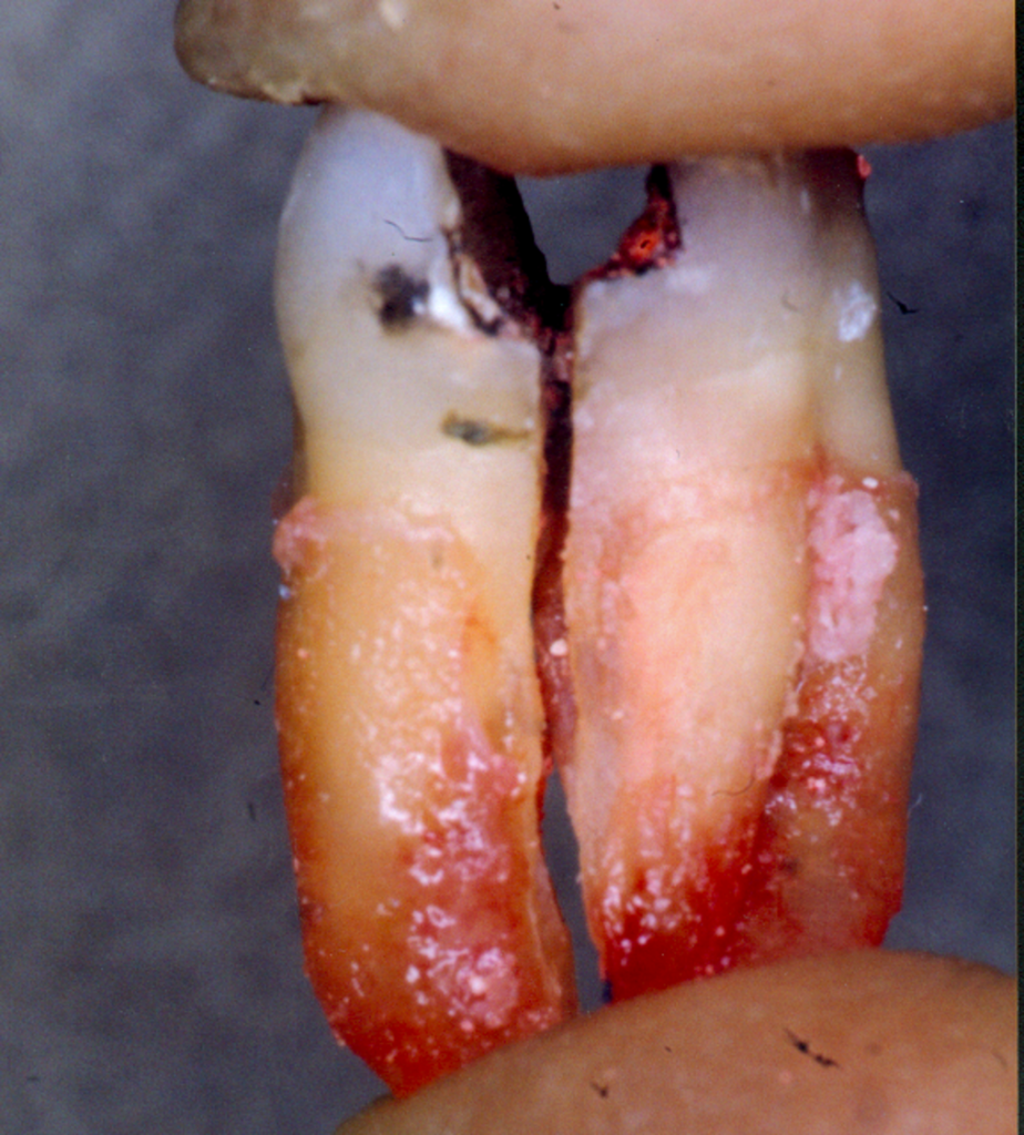 Extracted tooth with severe midline crack and complete fracture