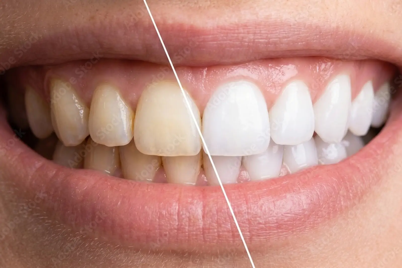 Professional Tooth Whitening Treatment