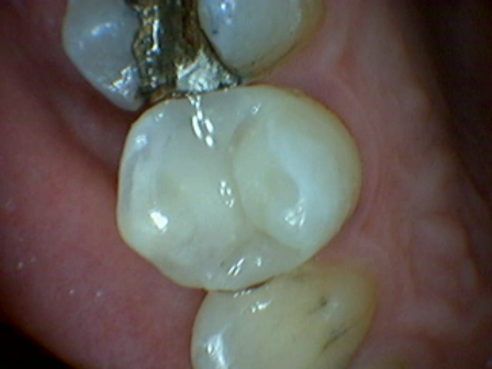 Premolar tooth repaired with white composite filling by Dr. Alfie Chan