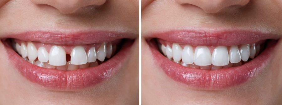 Dental before and after diastema closure with veeners